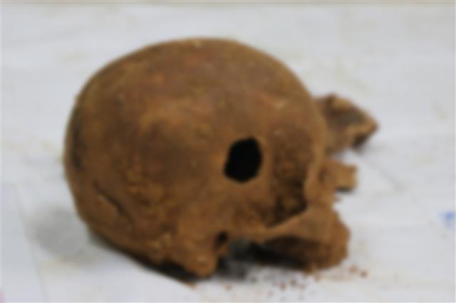 옛 광주교도소 무연고자 묘지에서 발견된 40여구의 신원미상 유골 가운데 구멍이 뚫린 머리뼈. 광주 연합뉴스