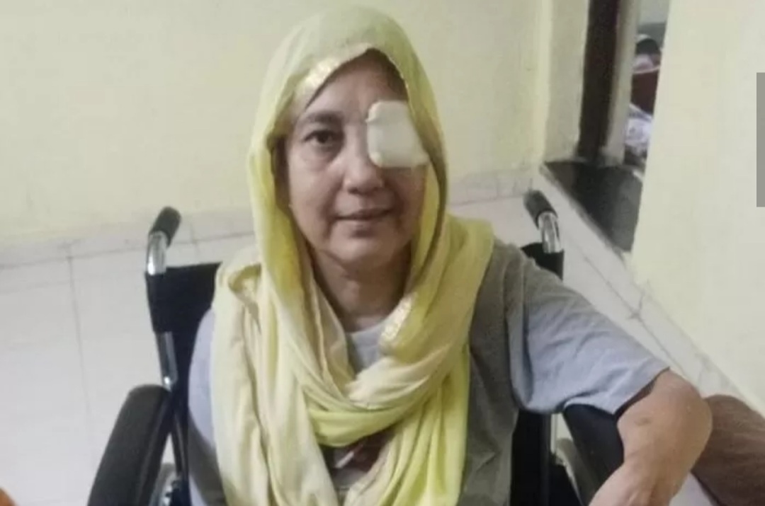 곰팡이균 감염돼 안구를 제거한 47세 인도 여성 닐람 바크쉬. 홍콩 사우스차이나모닝포스트(SCMP) 캡처 