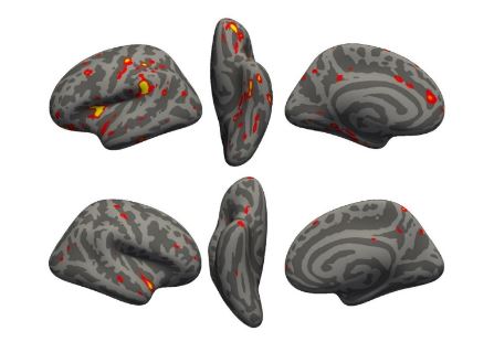 코로나 바이러스가 뇌에 미치는 영향을 알아보기 위해 뇌를 스캔한 영상. 출처:바이오뱅크