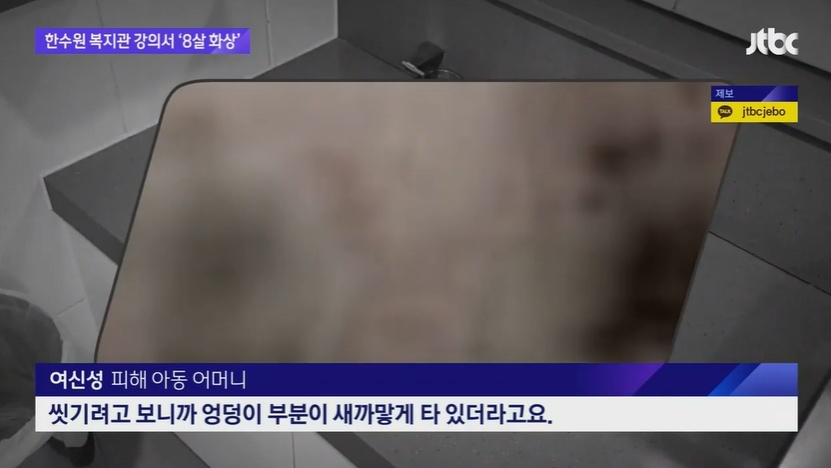 과학 강의 듣던 8살 심각한 화상. JTBC 뉴스 캡처