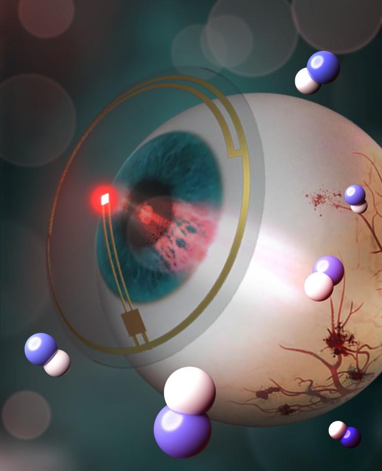 당뇨성 안질환 치료하는 LED 콘택트렌즈 개발