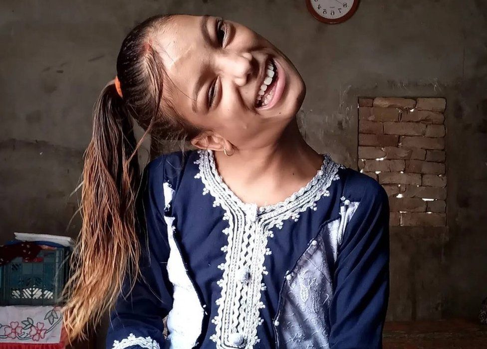 파키스탄 소녀 아프신 굴은 12년 동안 이렇게 목이 90도로 꺾인 채 살아왔다. 하지만 인도 의사의 수술 덕에 지금은 이렇게 세상을 똑바로 바라볼 수 있게 됐다. 영국 BBC 홈페이지 캡처