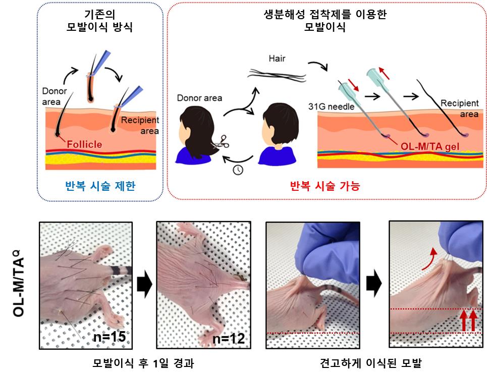 생분해성 접착제를 이용한 모발 이식 방식