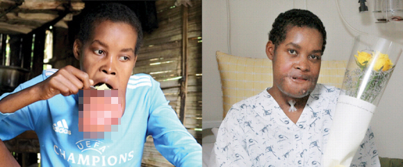 입안에 생긴 거대 종양으로 따돌림받던 마다가스카르 청년 플란지(22)가 서울아산병원에서 수술한 후 새 삶을 찾았다. 사진은 수술 전후 비교. 서울아산병원 제공