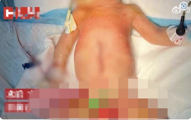 중국 선전시에서 머리와 심장이 없이 기형적으로 자란 기생 쌍둥이를 달고 태어난 태아가 정상적인 분리 수술에 성공했다. SNS 캡처 