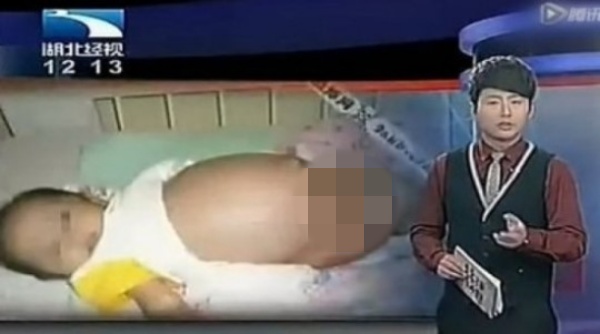 7개월된 남아의 뱃속에서 ‘기생 태아’가 발견돼 제거 수술을 감행한 사례. 중국 케이블 후베이징스는안후이성 쑤숭현의 더우더우라는 아이의 뱃속에서 ‘기생 태아’가 발견됐다고 보도했다. 해당보도 캡처