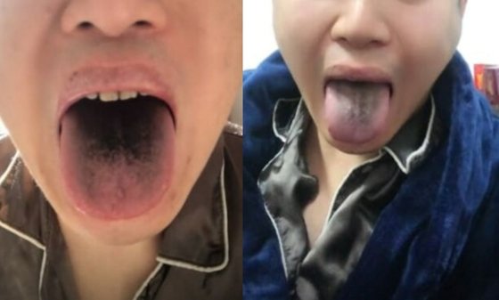 중국 톈진에 거주하는 한 남성이 코로나19 확진 판정을 받은 뒤 혀가 검게 변했다고 주장했다. 유튜브 캡처
