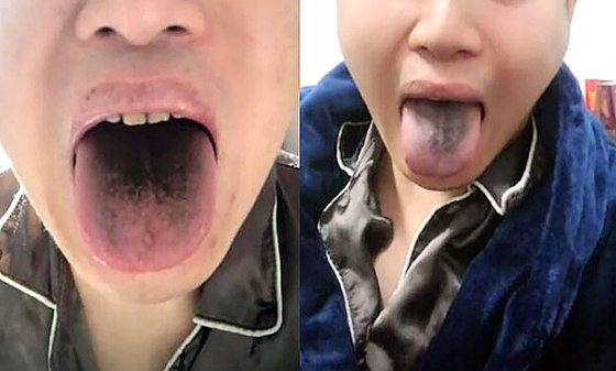 톈진의 한 남성이 코로나 확진 판정을 받은 뒤 혀가 검게 변했다고 주장했다. 웨이보 갈무리