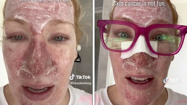 호주에 거주하는 48세 여성 멜리사 루이스(사진)가 어린 시절 자외선 차단제를 바르지 않고  땡볕에 태닝을 해 피부암에 걸렸다며 틱톡에 치료 과정을 공개했다. 사진=틱톡 갈무리