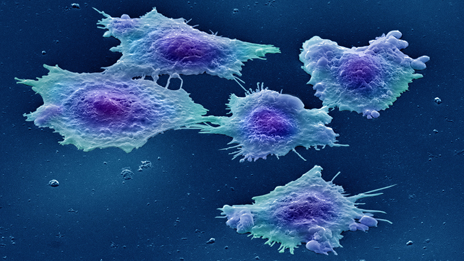 대장암 조직을 전자 현미경으로 촬영한 모습  미국 국립보건원(NIH) 제공