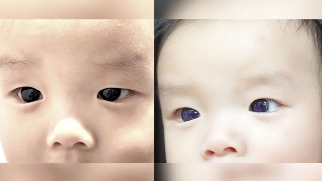 태국의 생후 6개월된 남아가 항바이러스제를 투여받고 눈동자 색깔이 어두운 갈색(왼쪽)에서 남색으로 변했다. 라이브사이언스