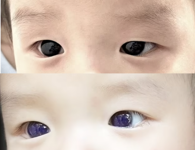 태국의 생후 6개월된 남아가 항바이러스제를 투여받고 눈동자 색깔이 어두운 갈색에서 남색으로 변했다. 라이브사이언스