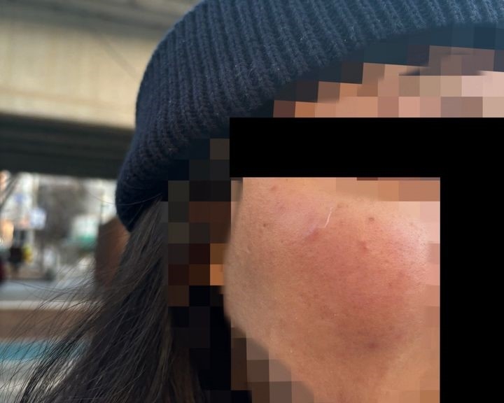 싱가포르 국적 유학생인 20대 여성이 지난 12일 오후 4시 30분쯤 동대문구의 횡단보도에서 모르는 남성에게 갑자기 주먹으로 4~5차례 얼굴을 맞았다며 경찰에 신고했다. 뉴시스(피해자 제공)