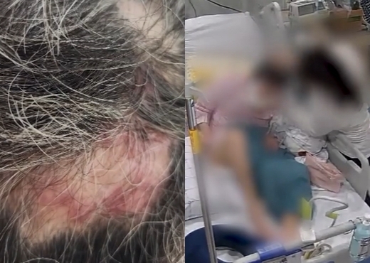 간병인이 환자를 학대하는 모습과 환자의 머리에 난 상처. SBS 보도화면 캡처