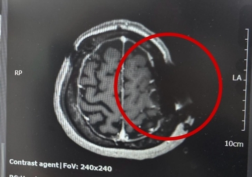 그라미 부근의 머리뼈에 쇠톱 날이 박혀 자기공명영상(MRI)이 제대로 찍히지 않았다. MRI는 자기공명을 이용하는데 금속 물질이 있어 정상적으로 작동하지 않았다고 한다. . 연합뉴스(B씨 제공)