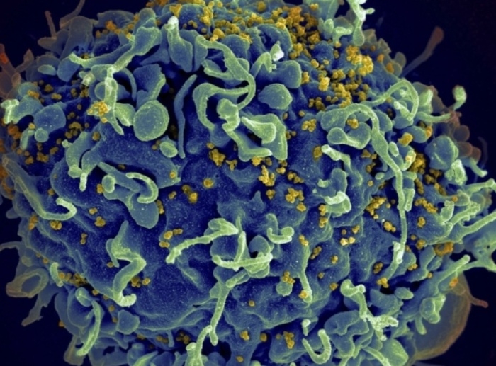 인간면역결핍바이러스에 공격받는 인간 T세포의 전자현미경 영상. AP 연합뉴스