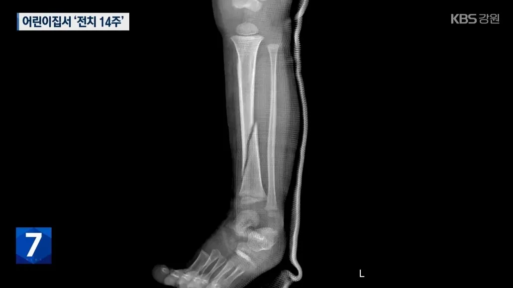 어린이집에서 정강이뼈가 골절된 30개월 아동의 엑스레이(X-Ray) 사진. KBS 뉴스 캡처