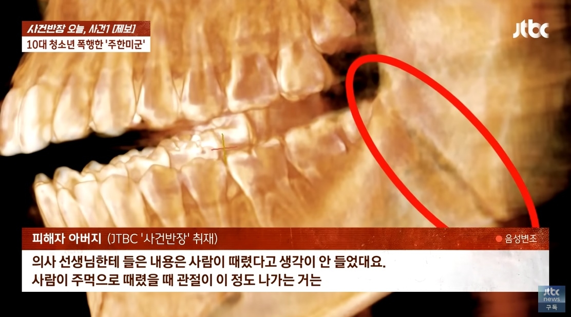 지난 17일 경기 평택시 평택역 인근에서 10대 남학생이 30대 주한미군에게 폭행을 당해 턱뼈가 골절되는 중상을 입었다. 자료 : JTBC ‘사건반장’