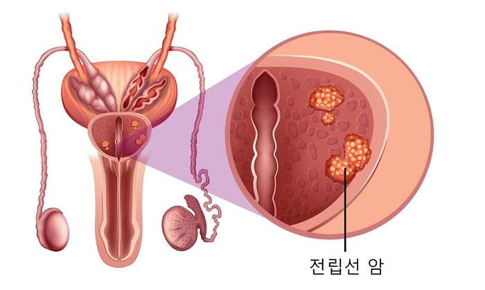 전립선암. 서울대학교병원 제공