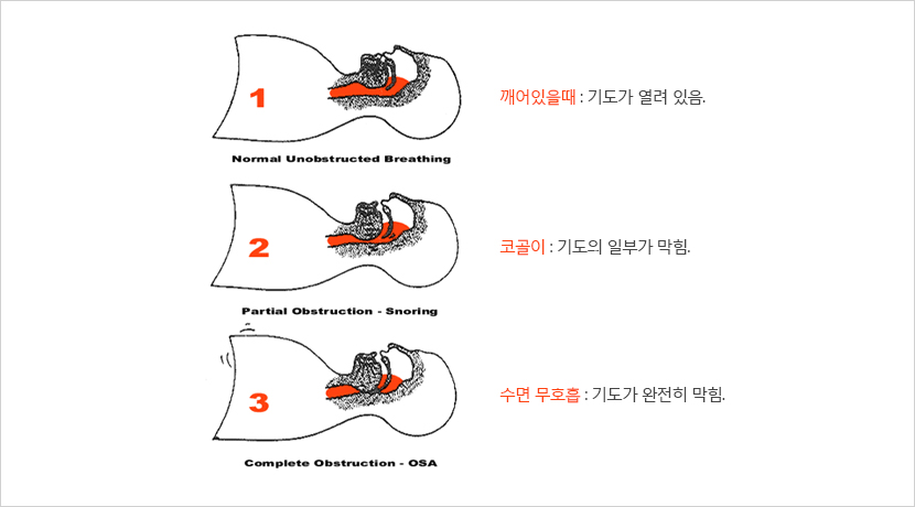 폐쇄성수면무호흡증(OSA). 대한수면연구학회 제공
