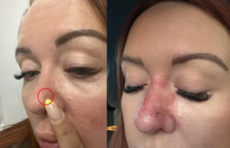 콧등에 생긴 붉은 점을 방치했다가 피부암 진단을 받은 영국 여성. SNS 캡처