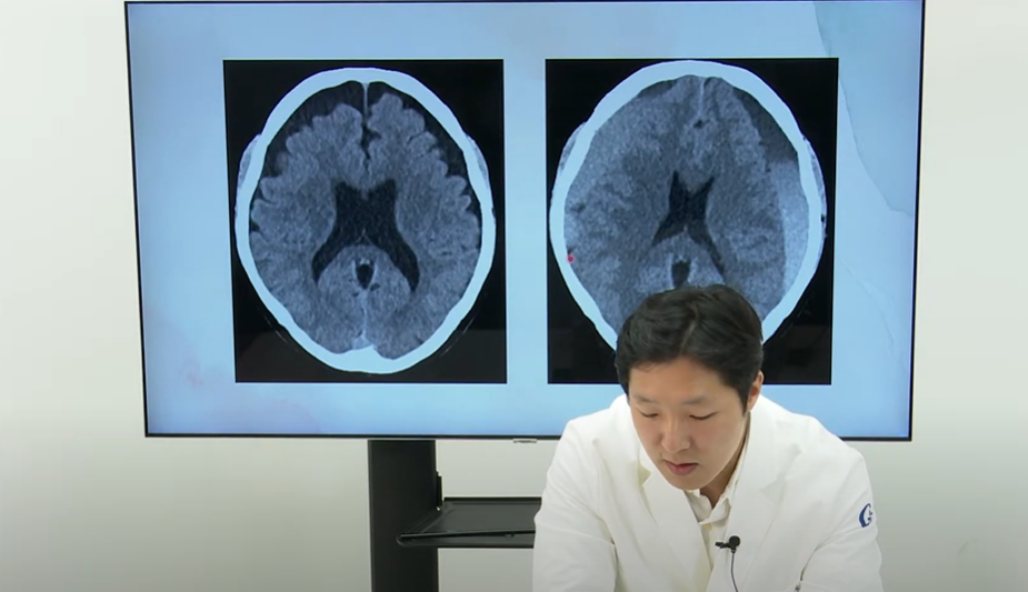 건강한 20대 남성이 ‘경막하혈종’으로 응급 수술을 받았다. 유튜브 채널 ‘의학채널 비온뒤’ 캡처