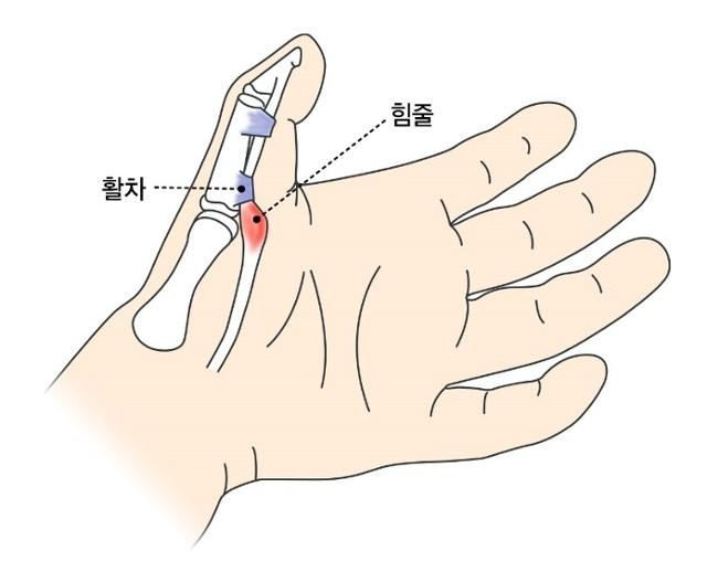 방아쇠 손가락과 관련된 힘줄과 활차의 설명도. 강동경희대병원 제공