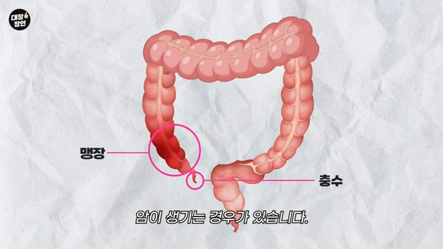 30~40대의 맹장암 발병률이 이전 세대에 비해 높다는 연구 결과가 나왔다. 유튜브 채널 ‘대장장인’ 캡처