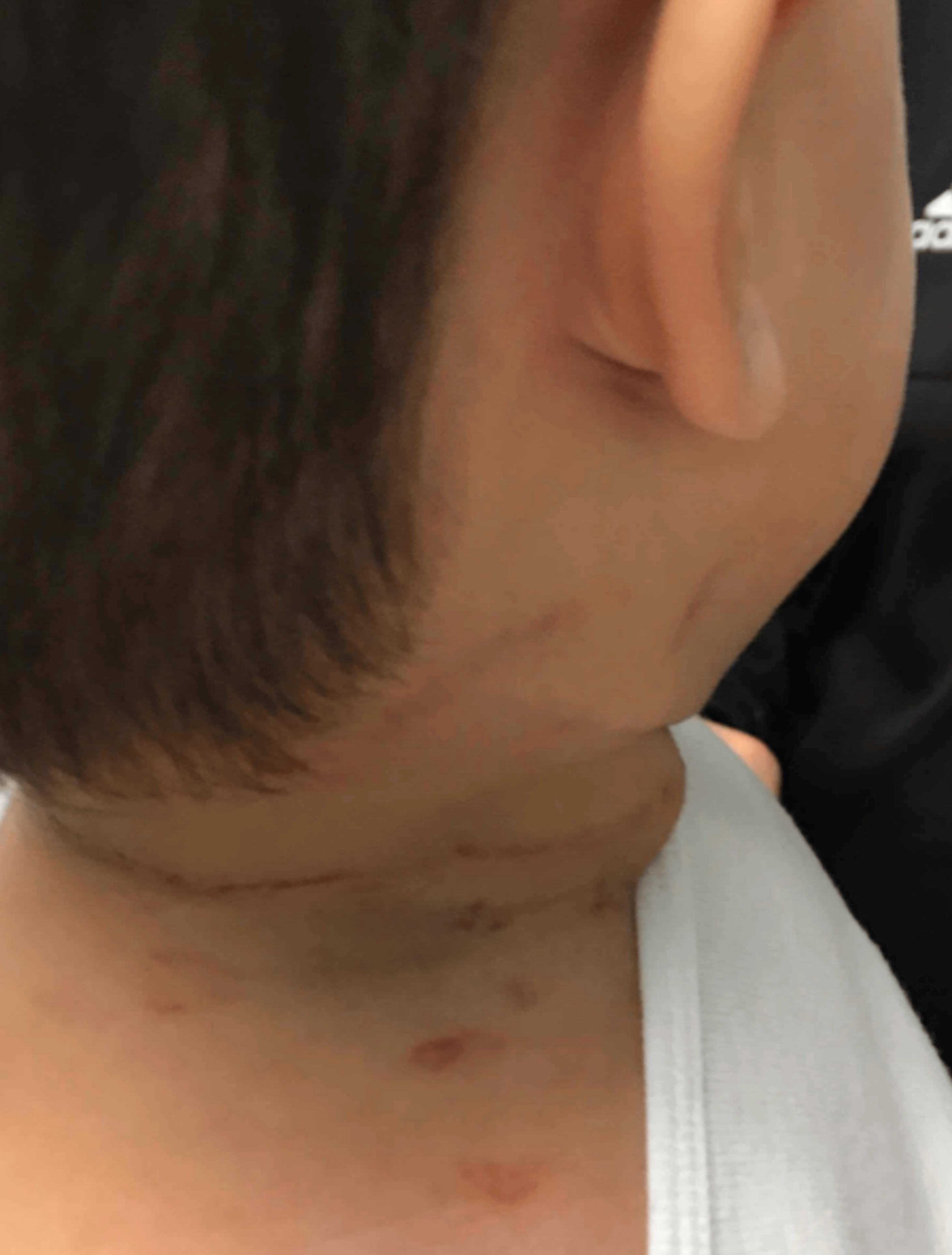 미국에서 생후 15개월 된 남자아이가 누나의 긴 머리카락에 목이 졸려 의식을 잃었다 되찾았다. 부모가 아이의 목에 감긴 머리카락을 손톱으로 긁어내는 과정에서 아이 목에 상처가 남았다. 큐어어스 홈페이지 캡처