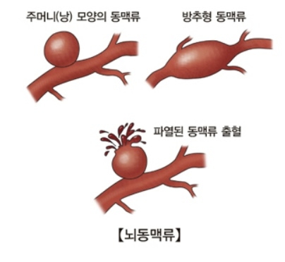 뇌동맥류 이미지. 자료 : 서울아산병원