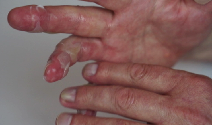 화상 관련 이미지. 기사와 직접적인 관련 없음. 아이클릭아트