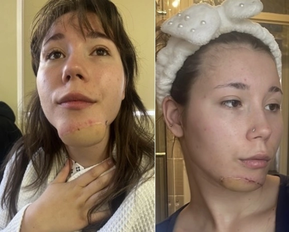 희귀 암 수술로 인해 턱 피부를 잃고 재건 수술을 받은 영국 여성이 턱에서 다리털이 난다고 호소했다. GoFundMe 페이지 캡처