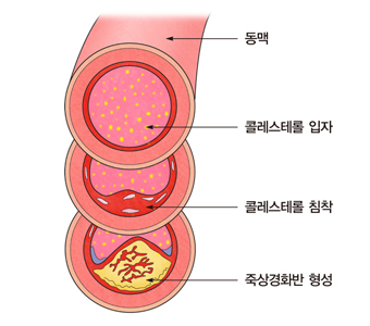 죽상경화증 진행도. 서울아산병원 제공
