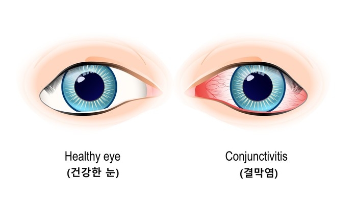 결막염 자료 사진. 서울대학교 병원 제공
