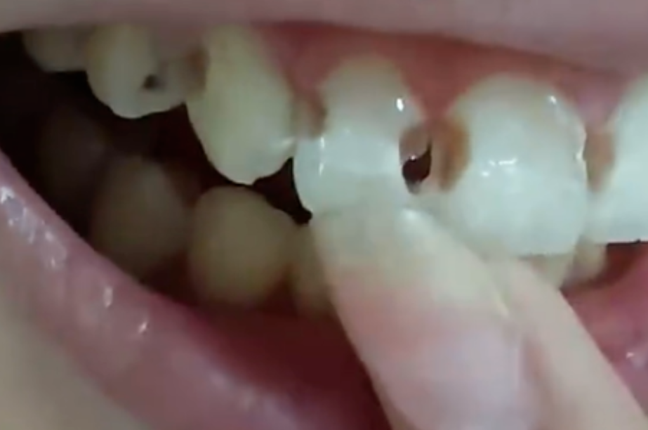5년간 치아 교정 치료를 받아 온 중국의 한 20세 여성이 구강 위생 관리가 제대로 이뤄지지 않아 치아 8개에 구멍이 뚫린 사연이 알려져 충격을 주고 있다. 웨이보