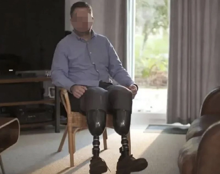 고의로 자신의 다리를 절단한 외과의사. BBC 캡처