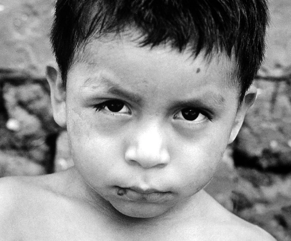 샤가스병 관련 이미지. 위키피디아