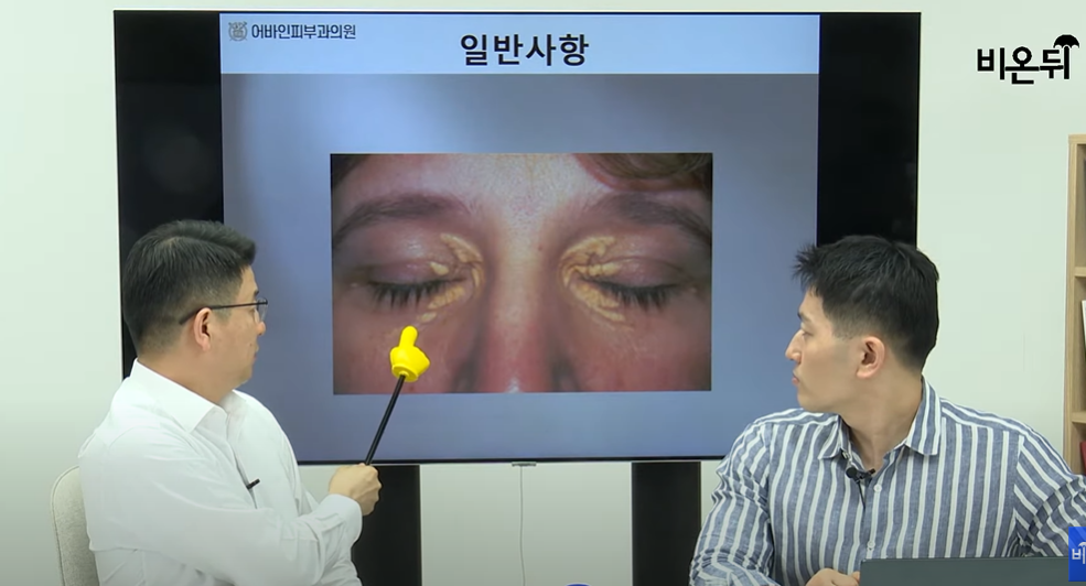 안검황색종. 유튜브 채널 ‘의학채널 비온뒤’ 캡처