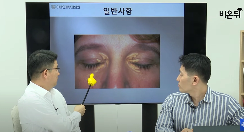 안검황색종. 유튜브 채널 ‘의학채널 비온뒤’ 캡처