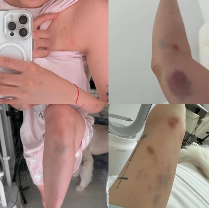 유튜버로 활동하는 대만인 여성이 서울 홍대 거리를 걷다 처음 보는 남성들의 헌팅을 거절한 뒤 폭행당했다며 사진을 공개해 논란이 일고 있다. 인스타그램 캡처