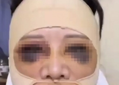 중국 상하이에 사는 58세 여성이 “눈 성형수술을 받은 뒤 부작용으로 판다가 됐다”고 호소했다. 자료 : 중국 허난방송 도시채널