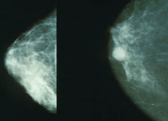 유방암 관련 이미지. 기사와 직접적인 관련 없음. 위키피디아