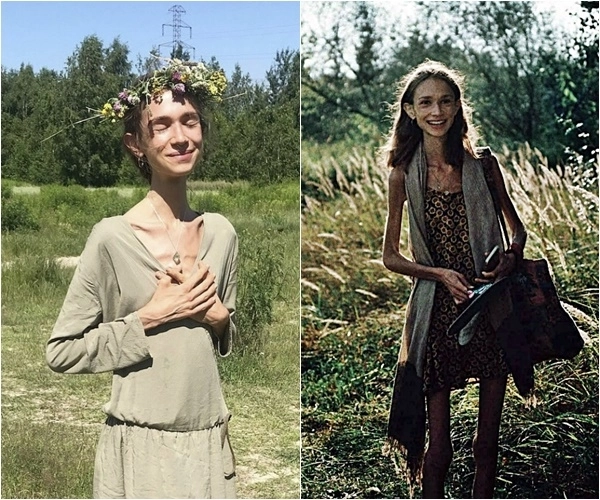 폴란드 출신인 카롤리나 크시자크(27)는 생과일만 섭취하는 극단적인 식단인 ‘과일주의(fruitarian)’를 고수하다 결국 숨졌다. 사망 당시 체중은 약 22㎏에 불과했다. 카롤리나 크시자크 인스타그램(@carolina.mariie) 캡처