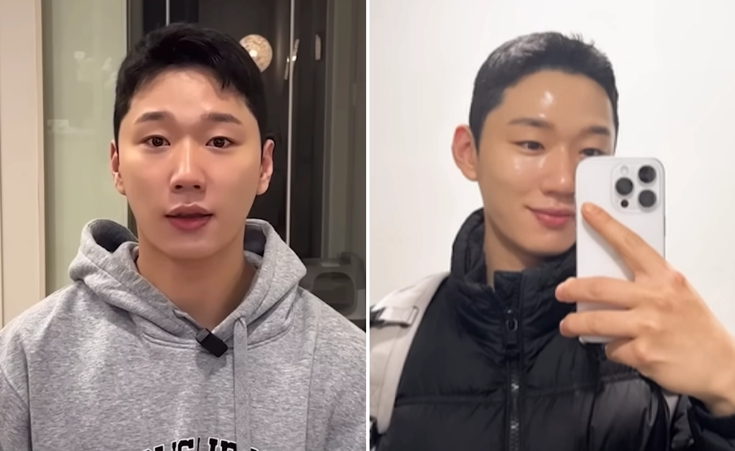 귀 필러 시술 전(왼쪽)과 후(오른쪽) 유튜버 준돌의 모습. 정면에서 볼 때 귀가 좀 더 잘 보이게 된 것이 보인다. 유튜브 채널 ‘준돌’ 캡처