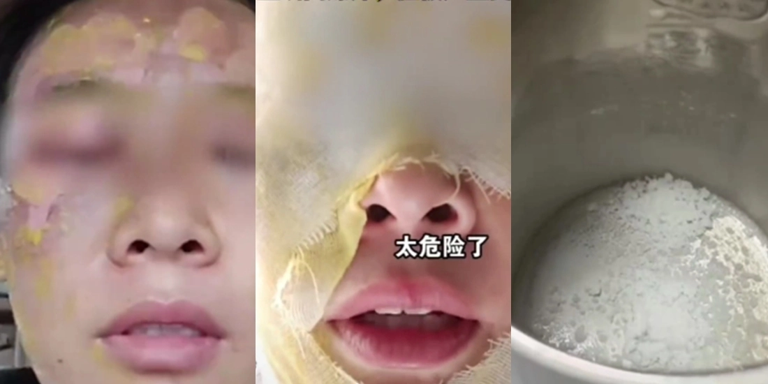 인터넷상에 떠도는 텀블러 세척법을 함부로 따라 했다가 얼굴에 큰 화상을 입은 중국 여성.