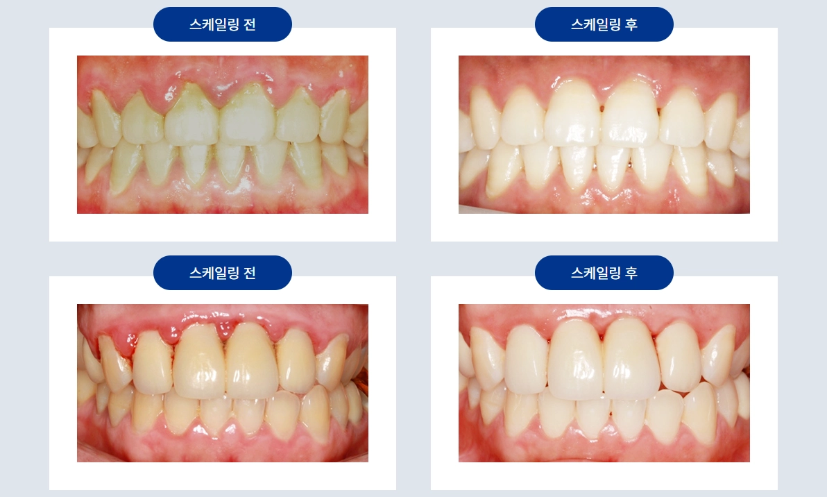 스케일링 이전과 이후 상태 비교 사진. 서울 보라매병원