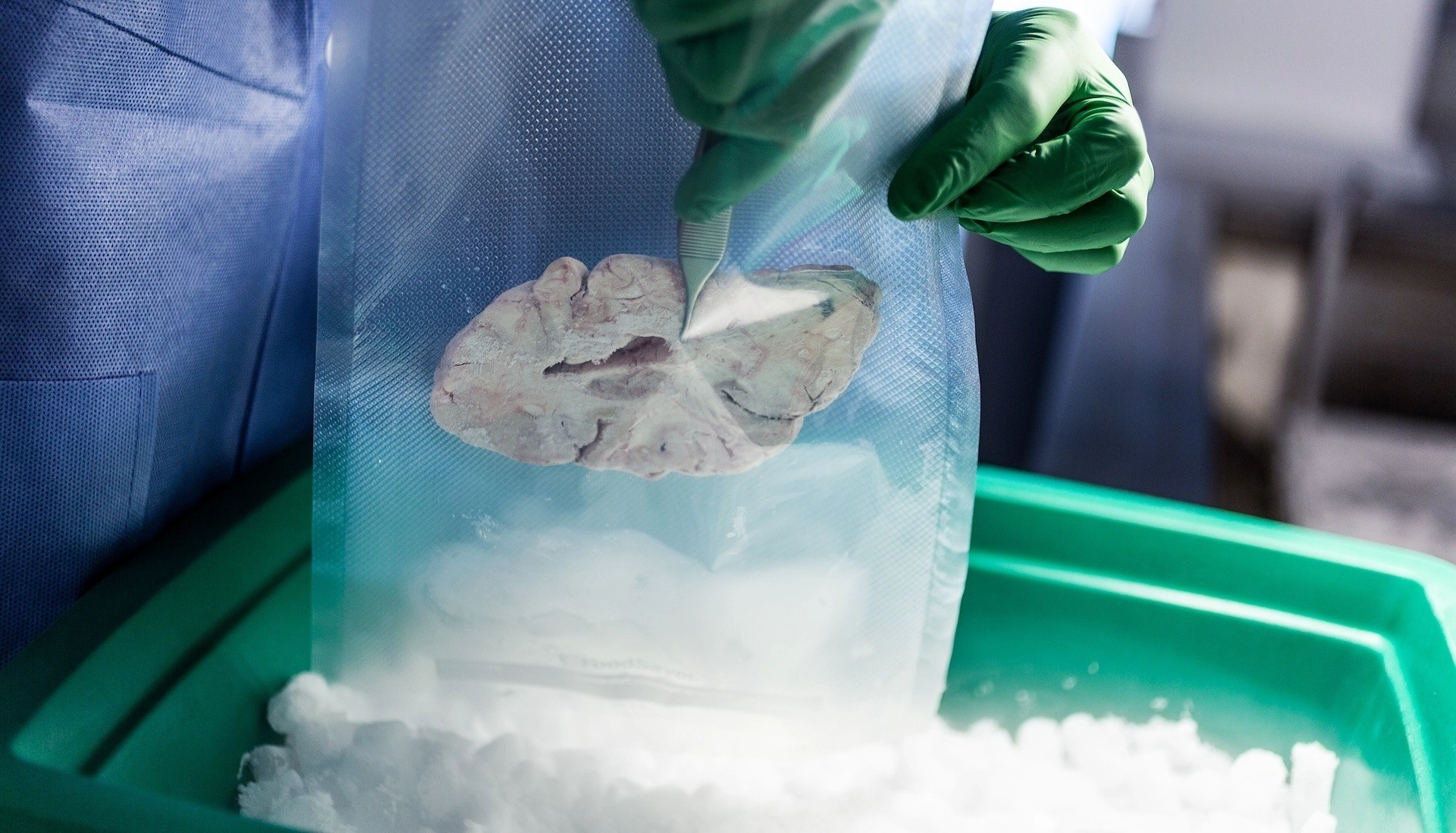 사망 후 연구소에 뇌를 기증한 환자의 뇌 일부. 단일 세포 및 공간 기술을 결합해 뇌세포 유형의 출현과 다양화·조직화를 추적해 뇌 네트워크 지도 초안이 작성됐다.
미국 앨런뇌 과학연구소 제공
