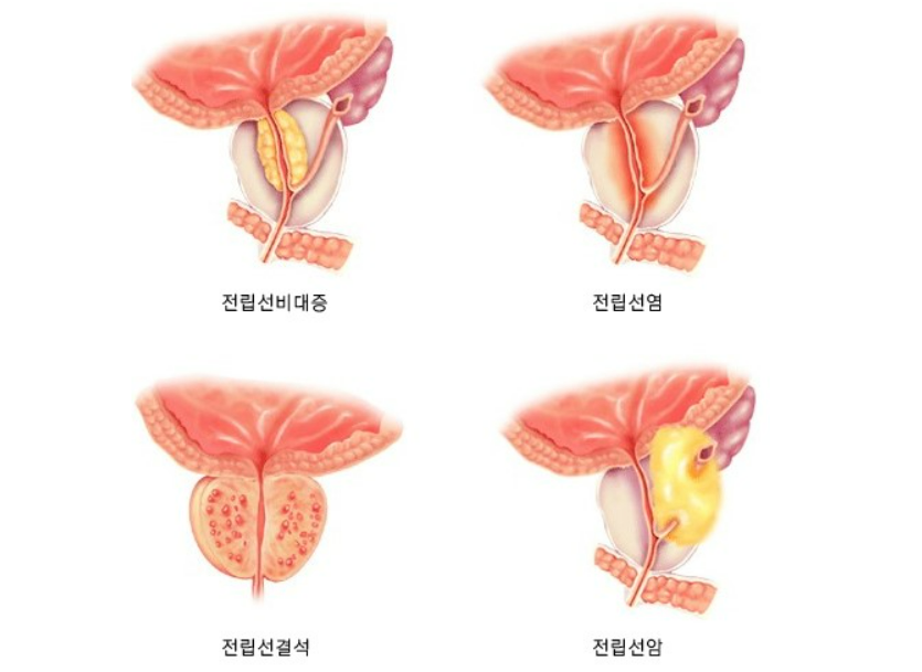 전립선질환 모식도. 국립암센터 제공