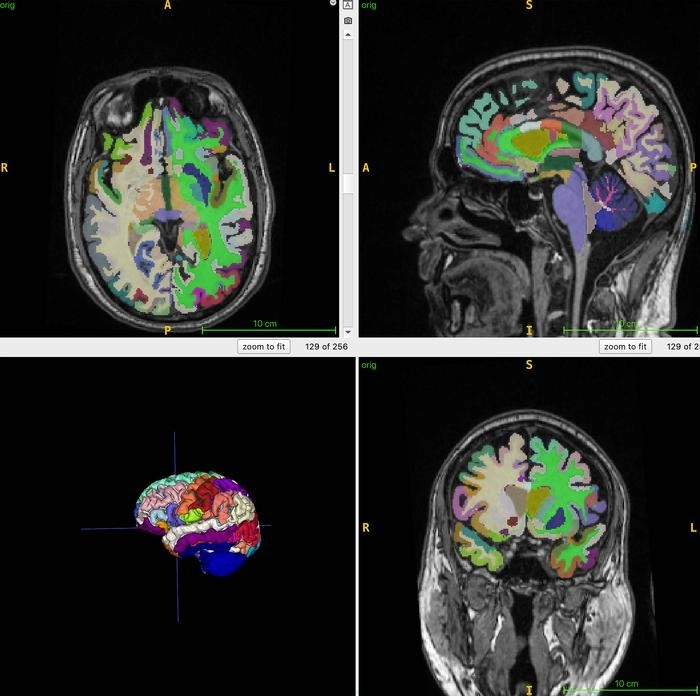 인공지능이 뇌 나이를 계산할 때 사용하는 3차원 T1 용적 MRI 스캔에서 얻은 데이터. 뇌를 여러 영역으로 나누어서 각 부분의 부피를 어떻게 측정했는지 보여준다.

미국 세인트루이스 워싱턴대 의대 제공
