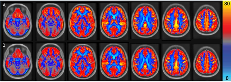 땅콩 섭취군(A)과 대조군(B)의 뇌 혈류량. ‘임상 영양학(CLINICAL NUTRITION)’ 12월호 캡처